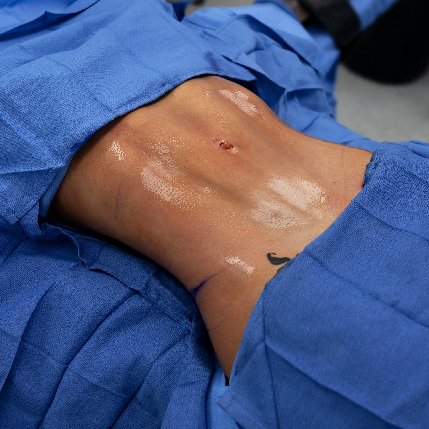 abdominal etching after