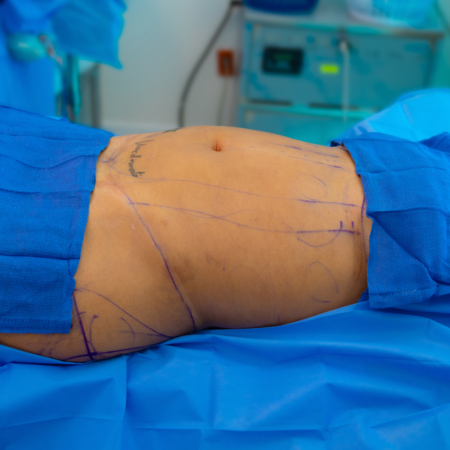 abdominal liposuction before