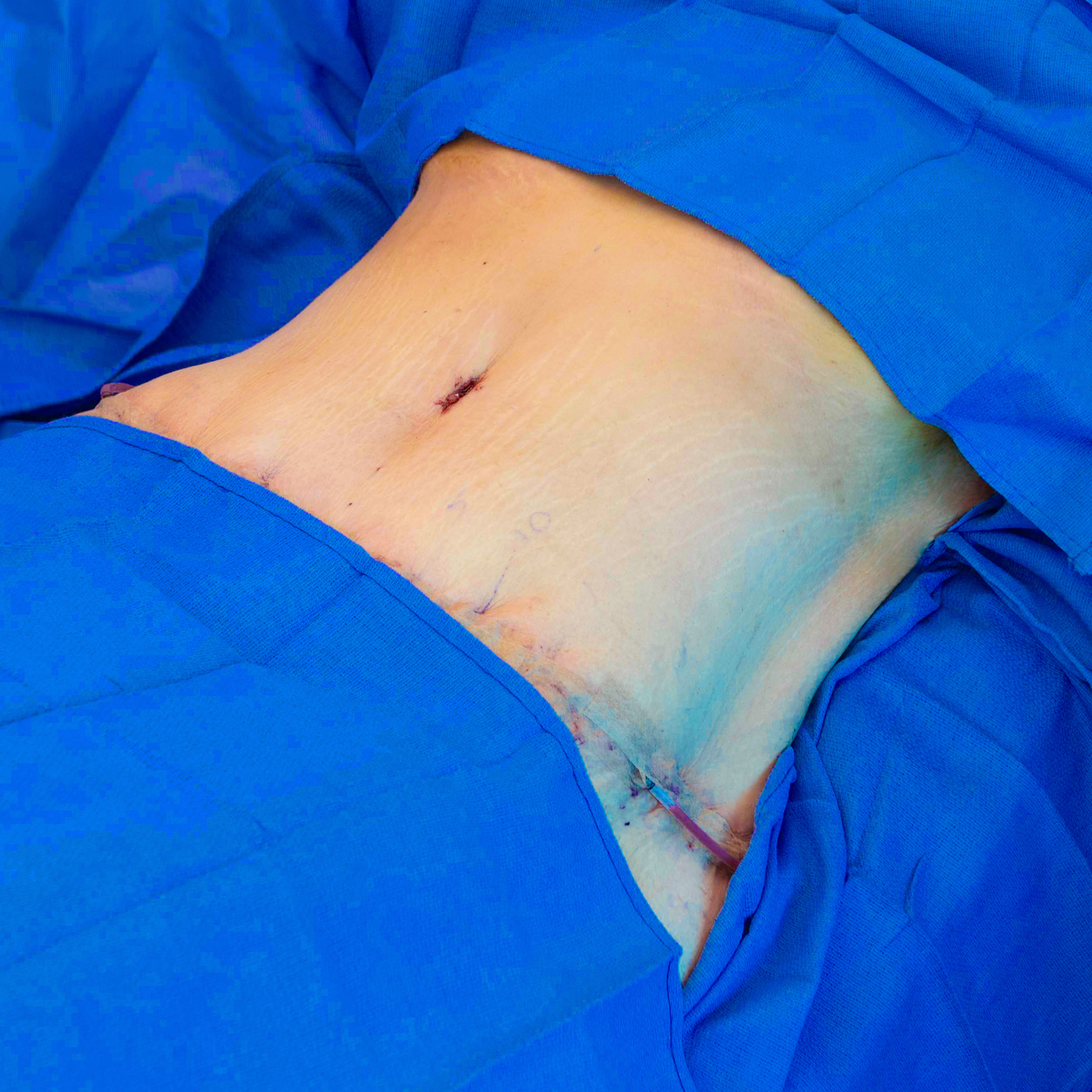 angle view tummy tuck after