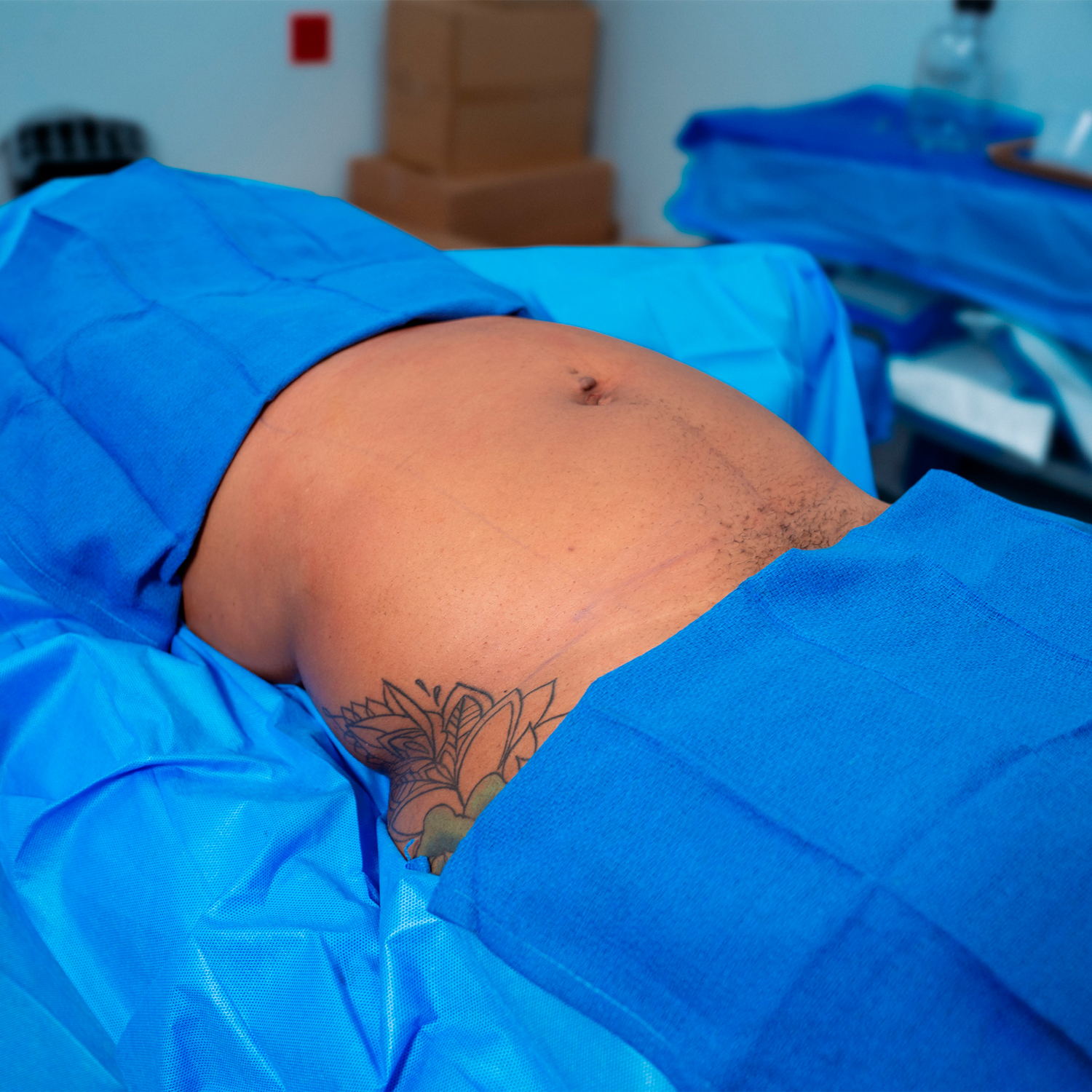 before lipo procedure by dr brewster