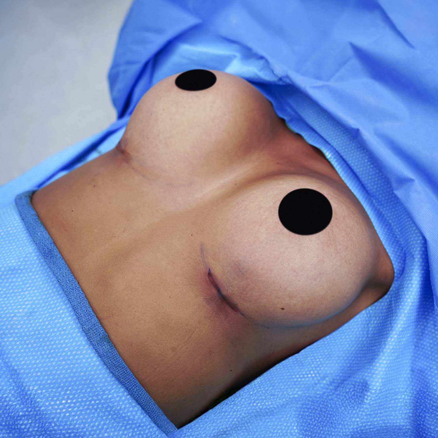 breast augmentation after