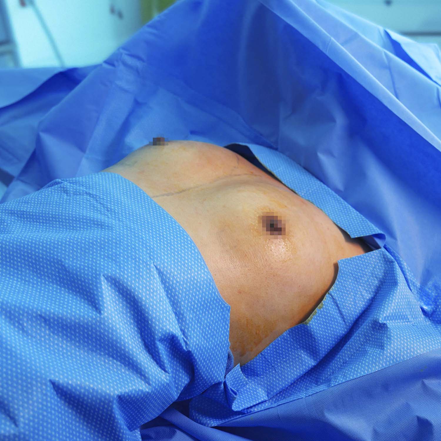 breast augmentation by dr nosrati before