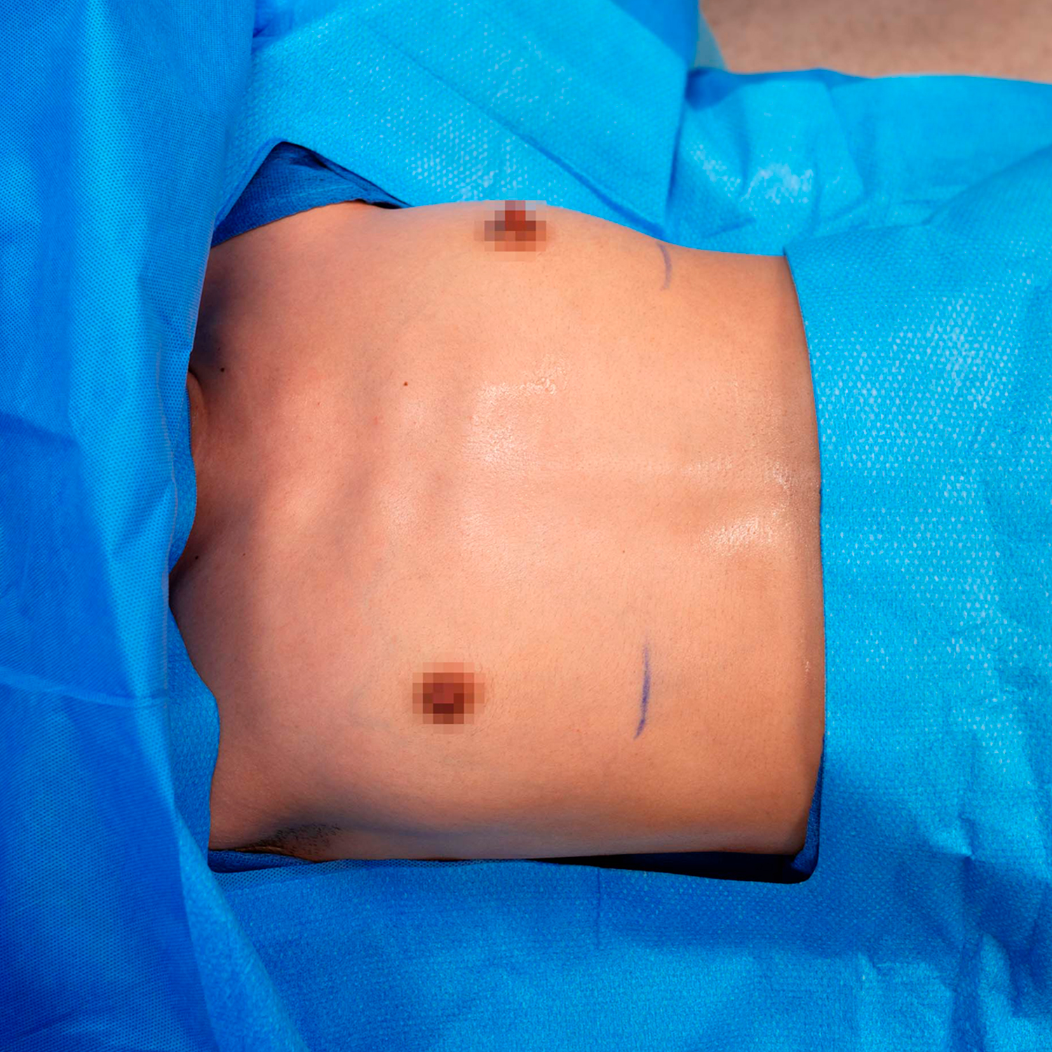 breast augmentation patient before digeronimo