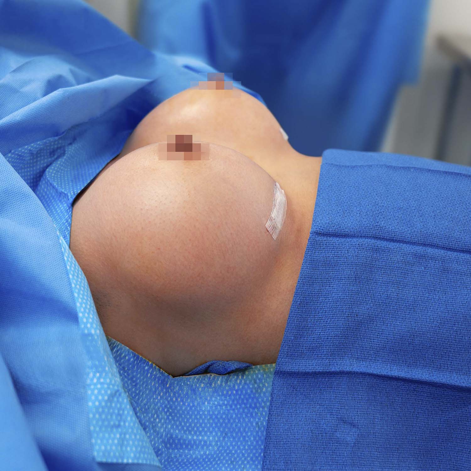 breast augmentation procedure after