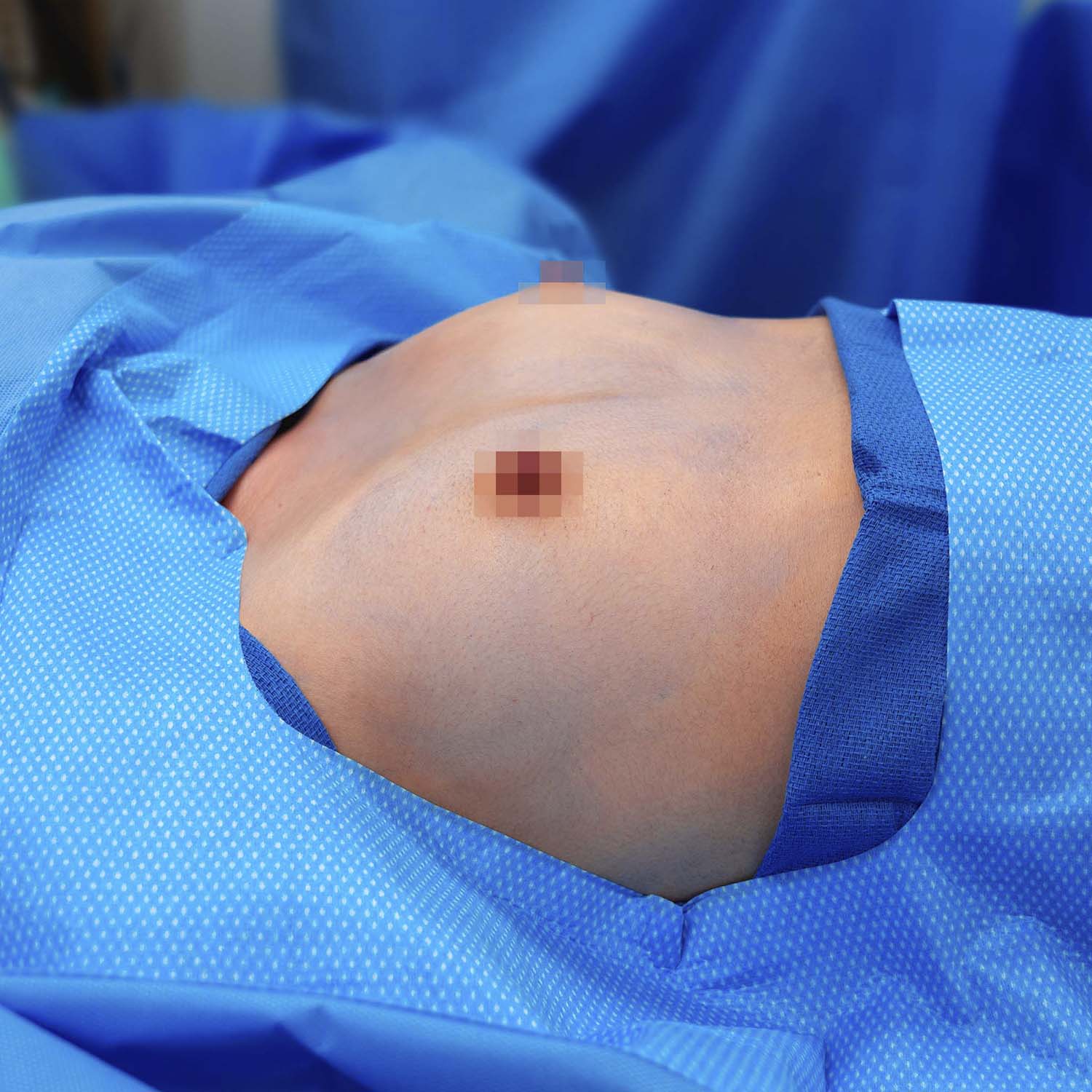 breast augmentation procedure before