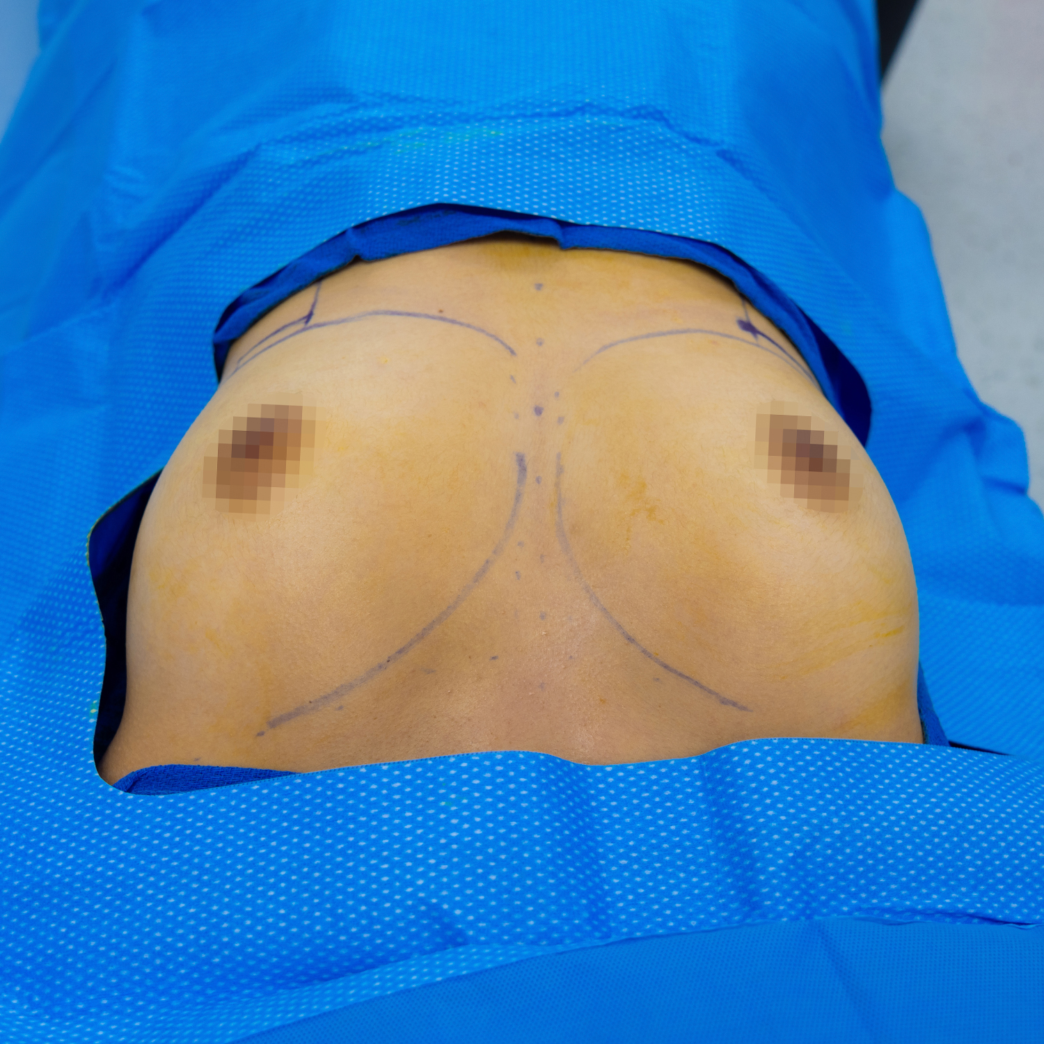 breast augmentation procedure before