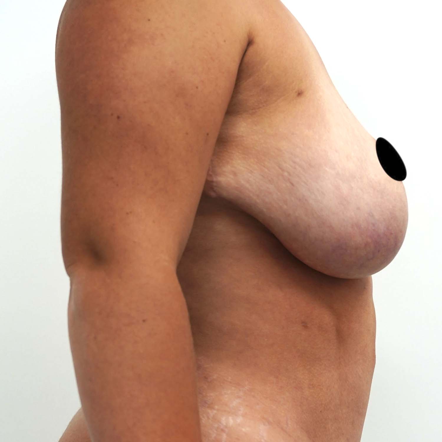 breast lift before