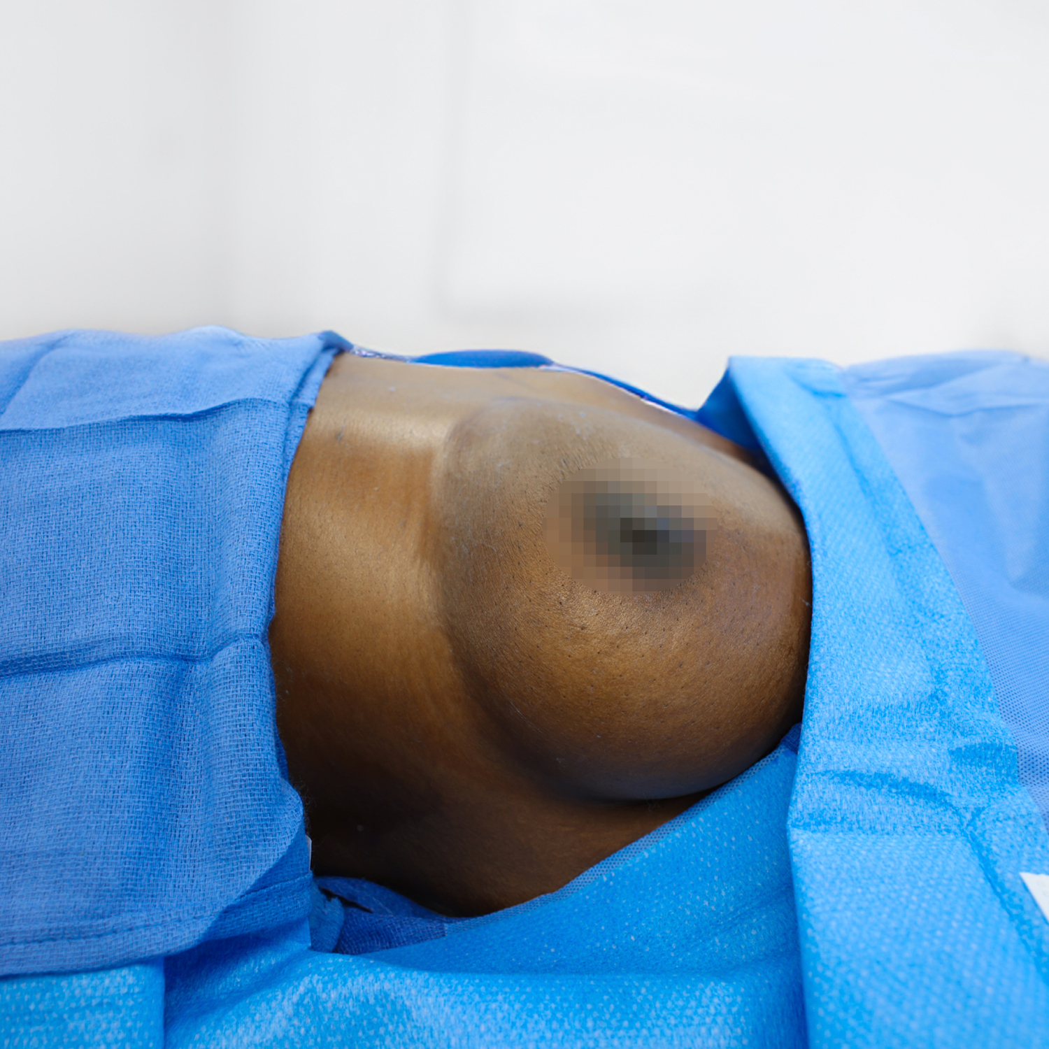 breast lift patient before