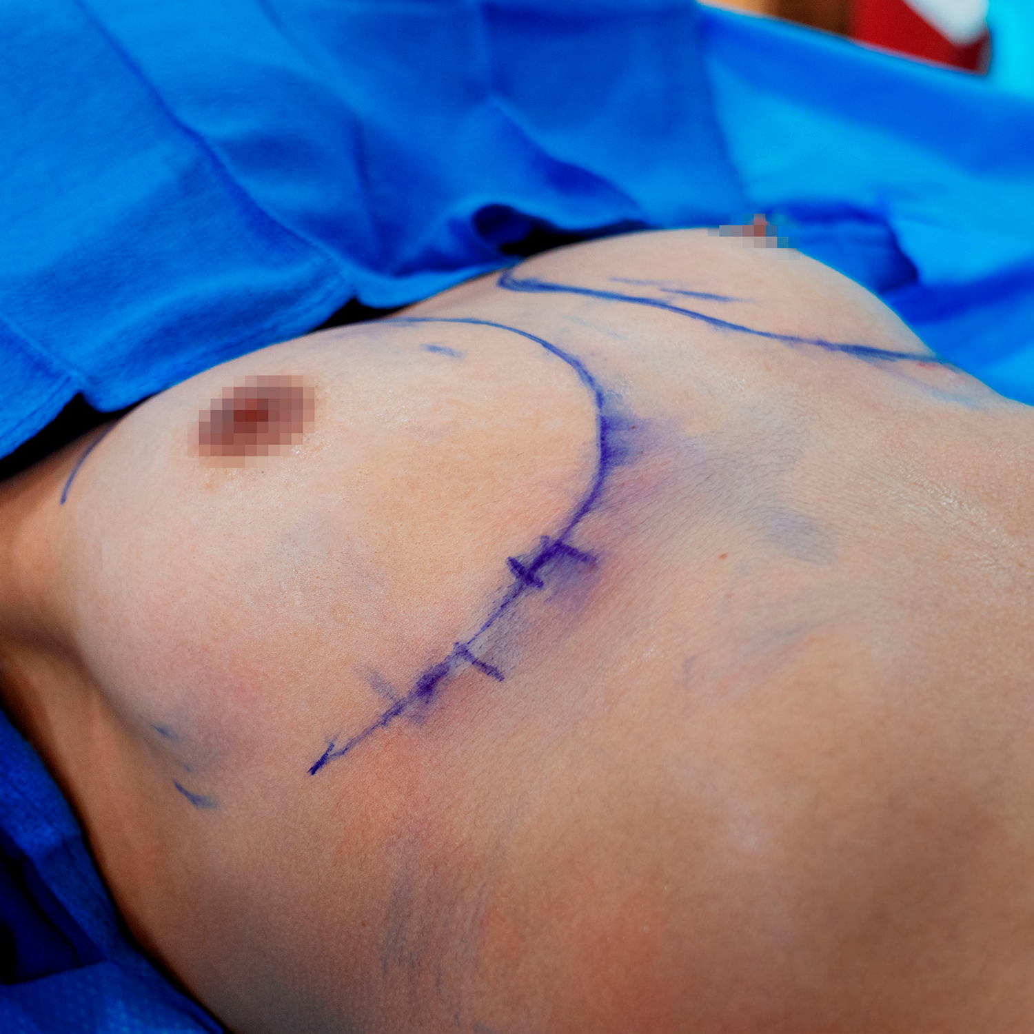 chest before breast augmentation brewster patient