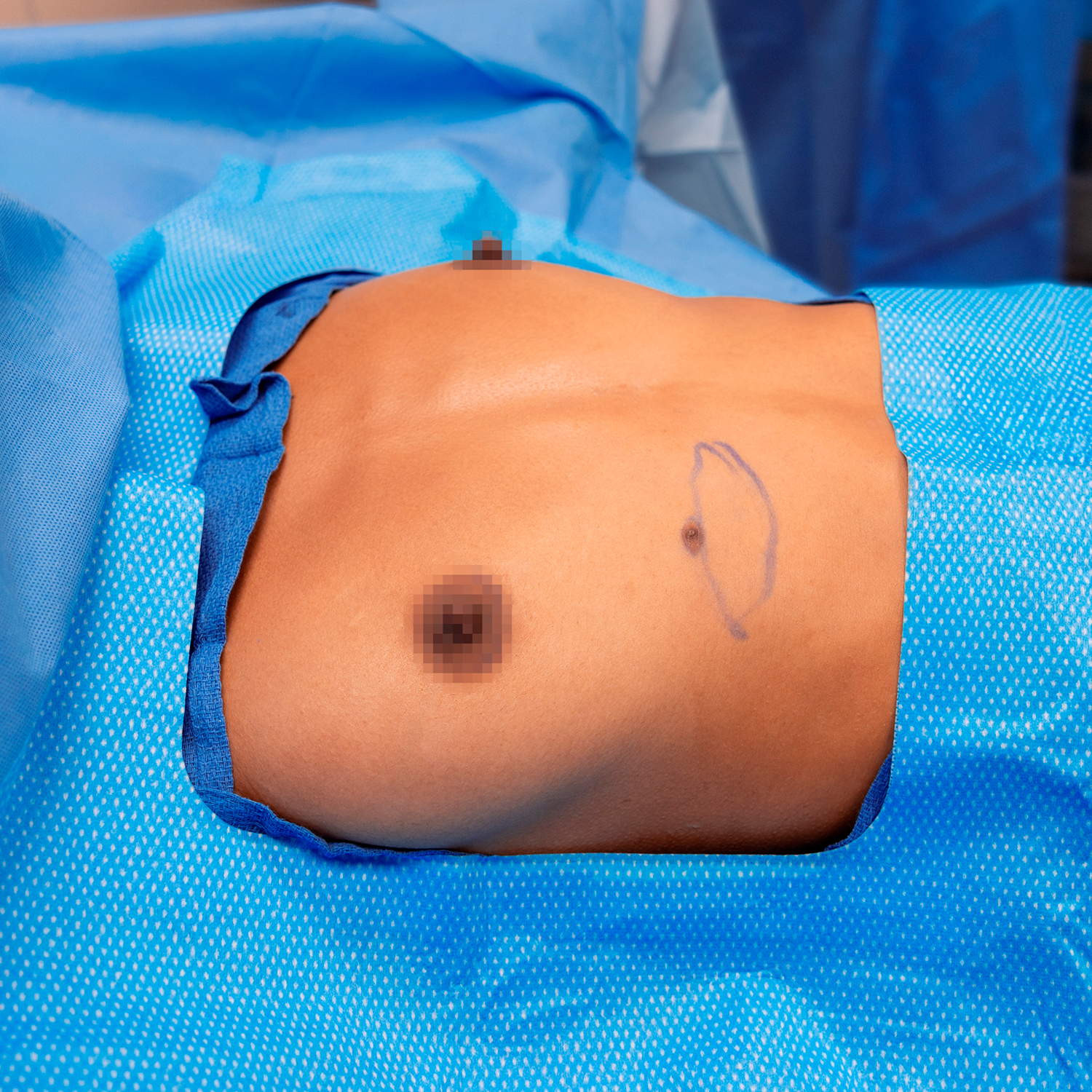 digeronimo patient before breast augmentation