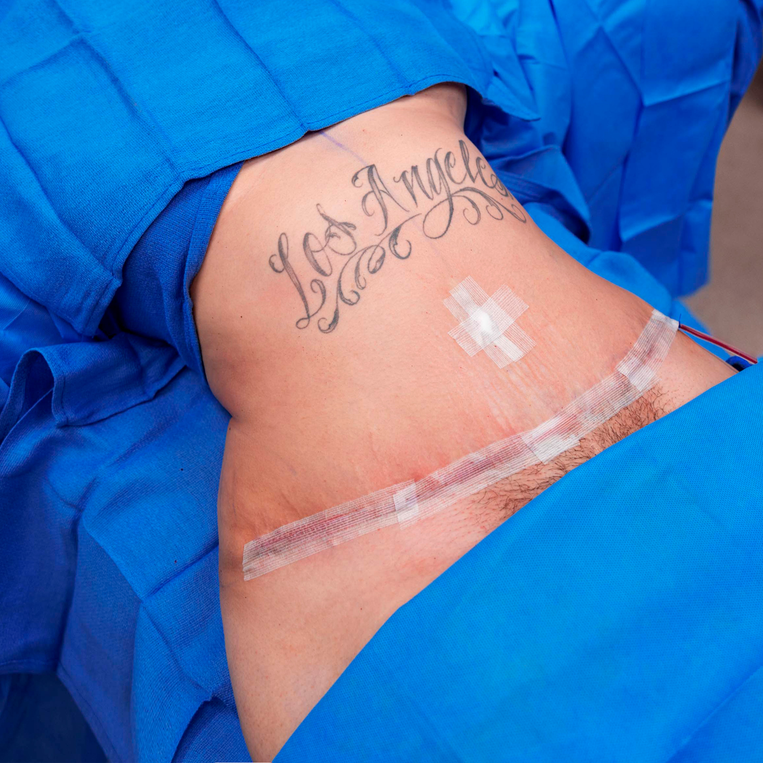 digeronimo tummy tuck patient after