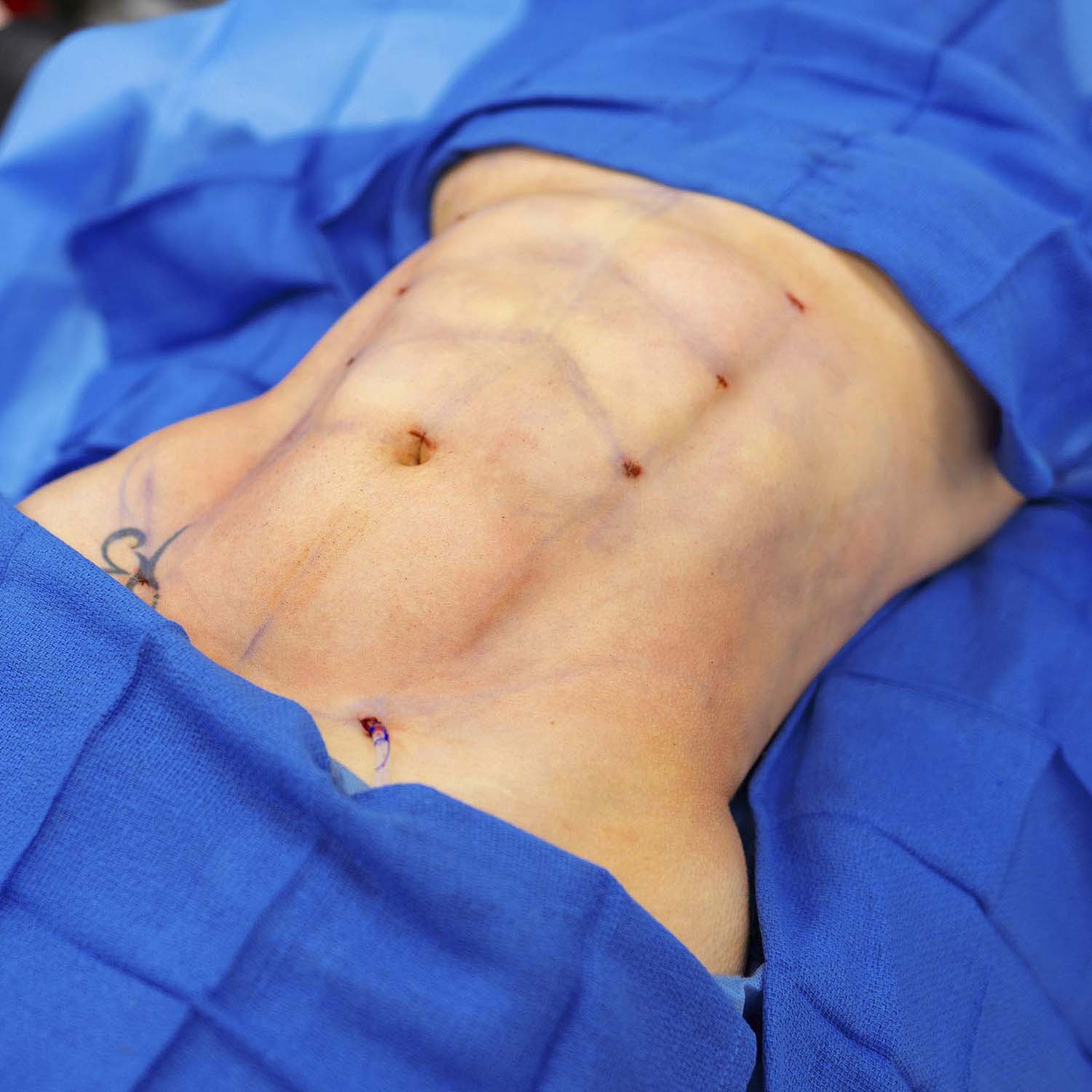 dr nosrati lipo hd after