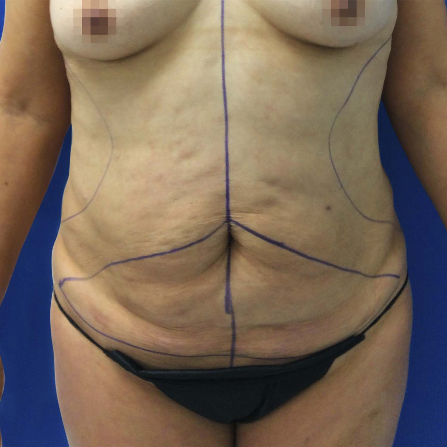 dr nosrati patient tummy tuck before