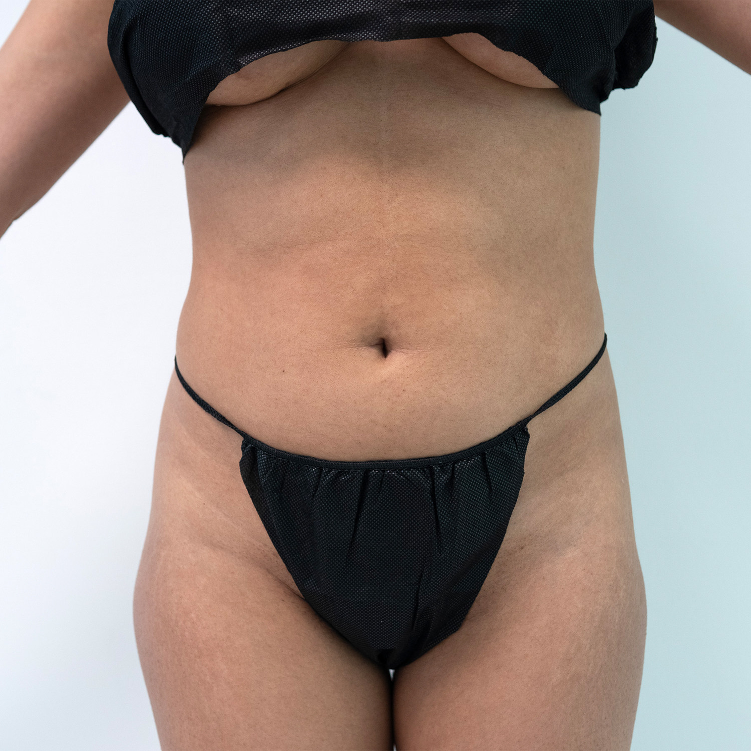 high definition lipo before