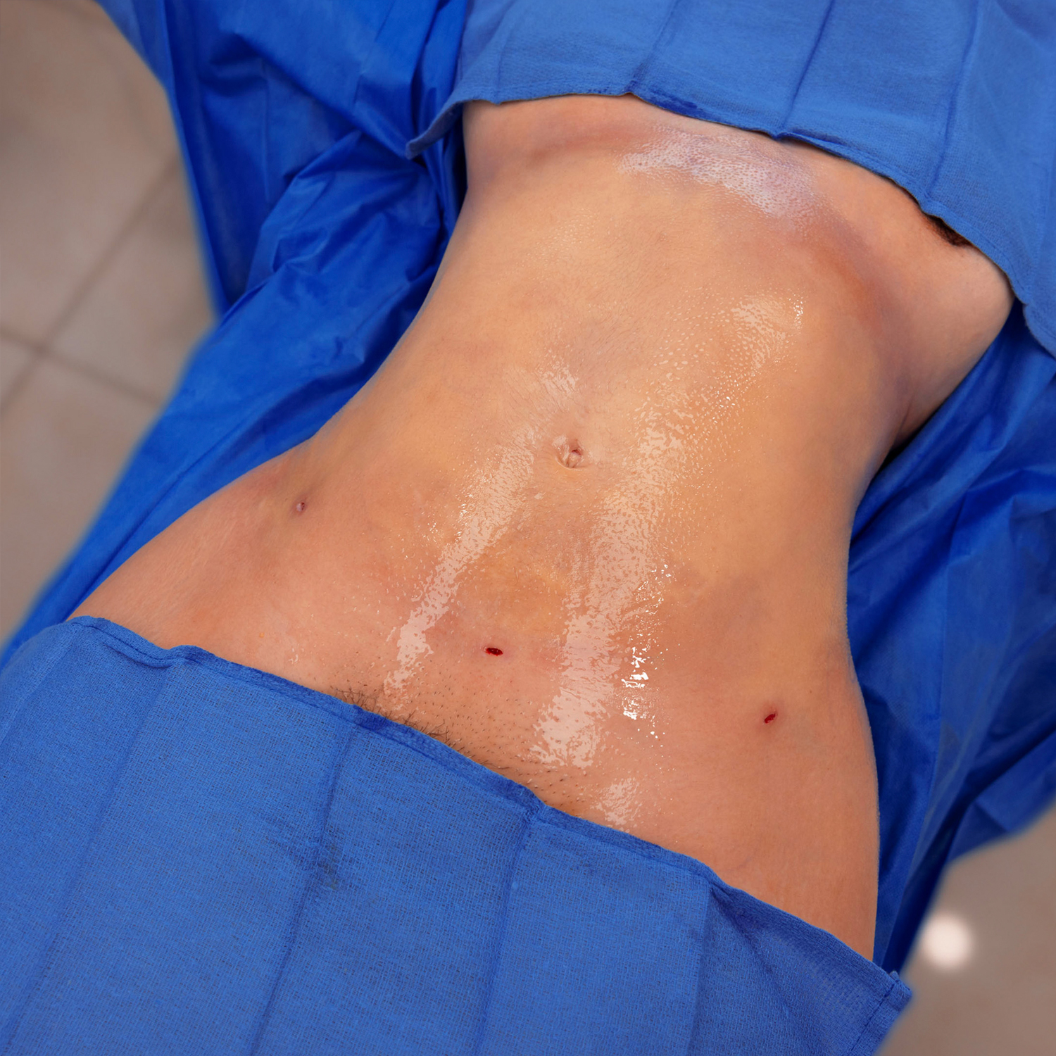 liposuction patient after