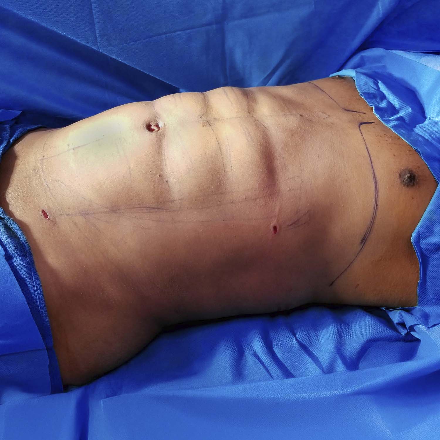 male lipo after