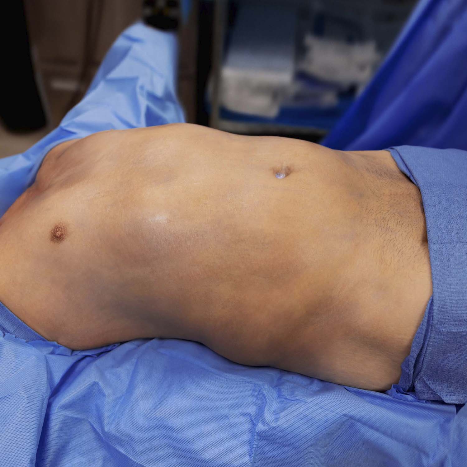 male liposuction before