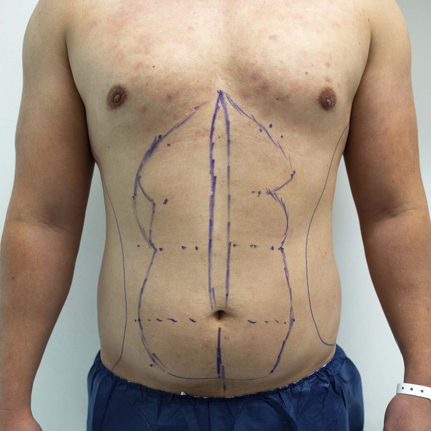 male liposuction by nosrati before