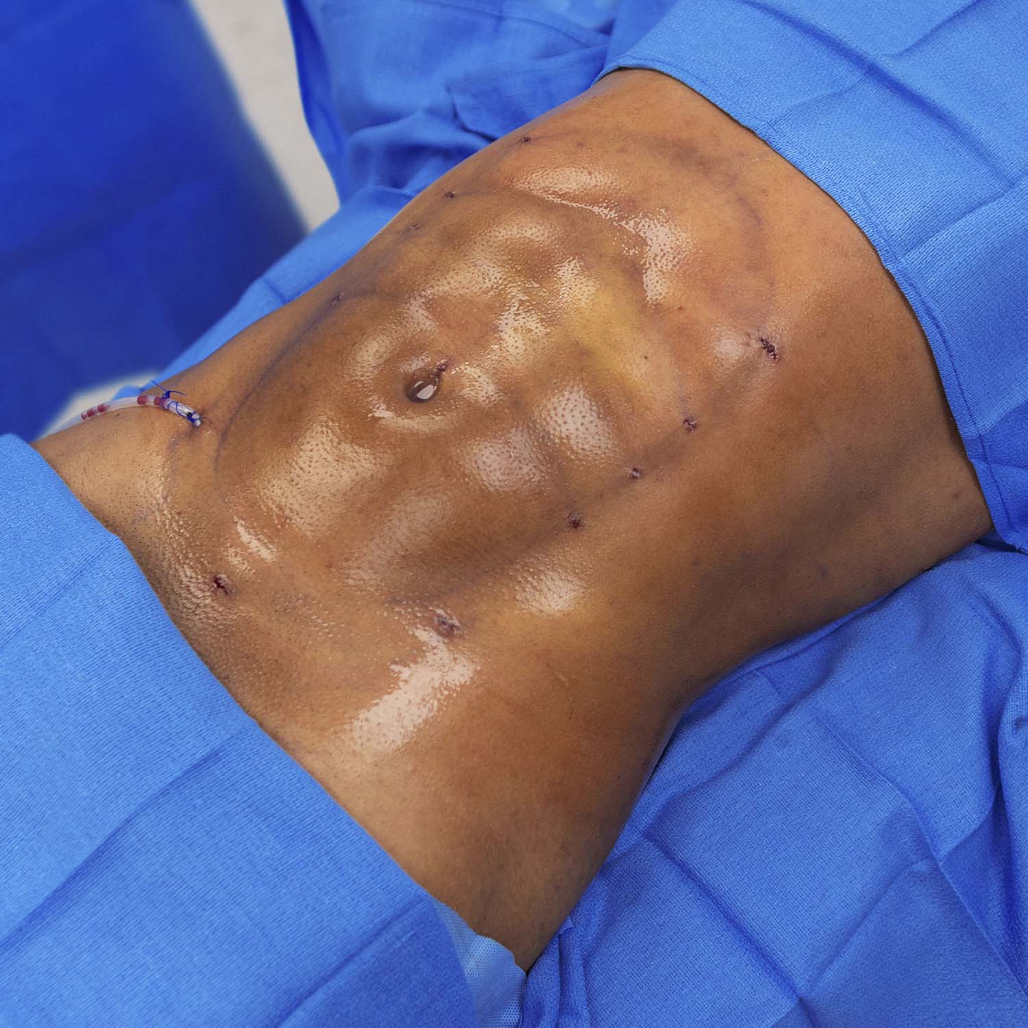 male patient by nosrati liposuction after