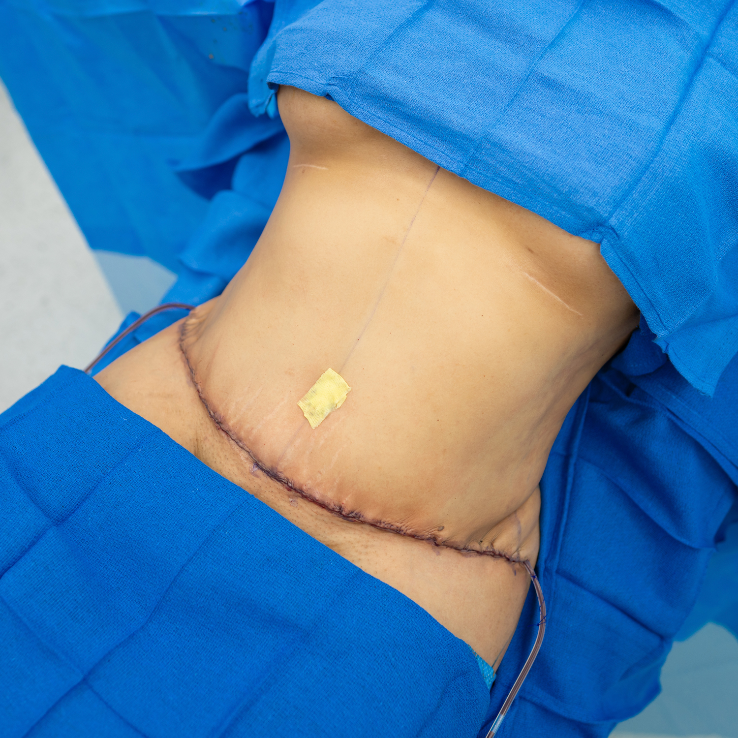 manny tummy tuck after