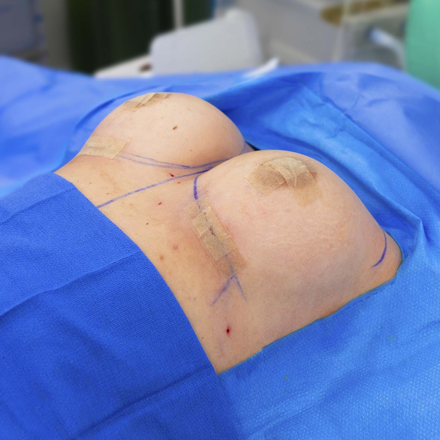 nosrati breast augmentation after