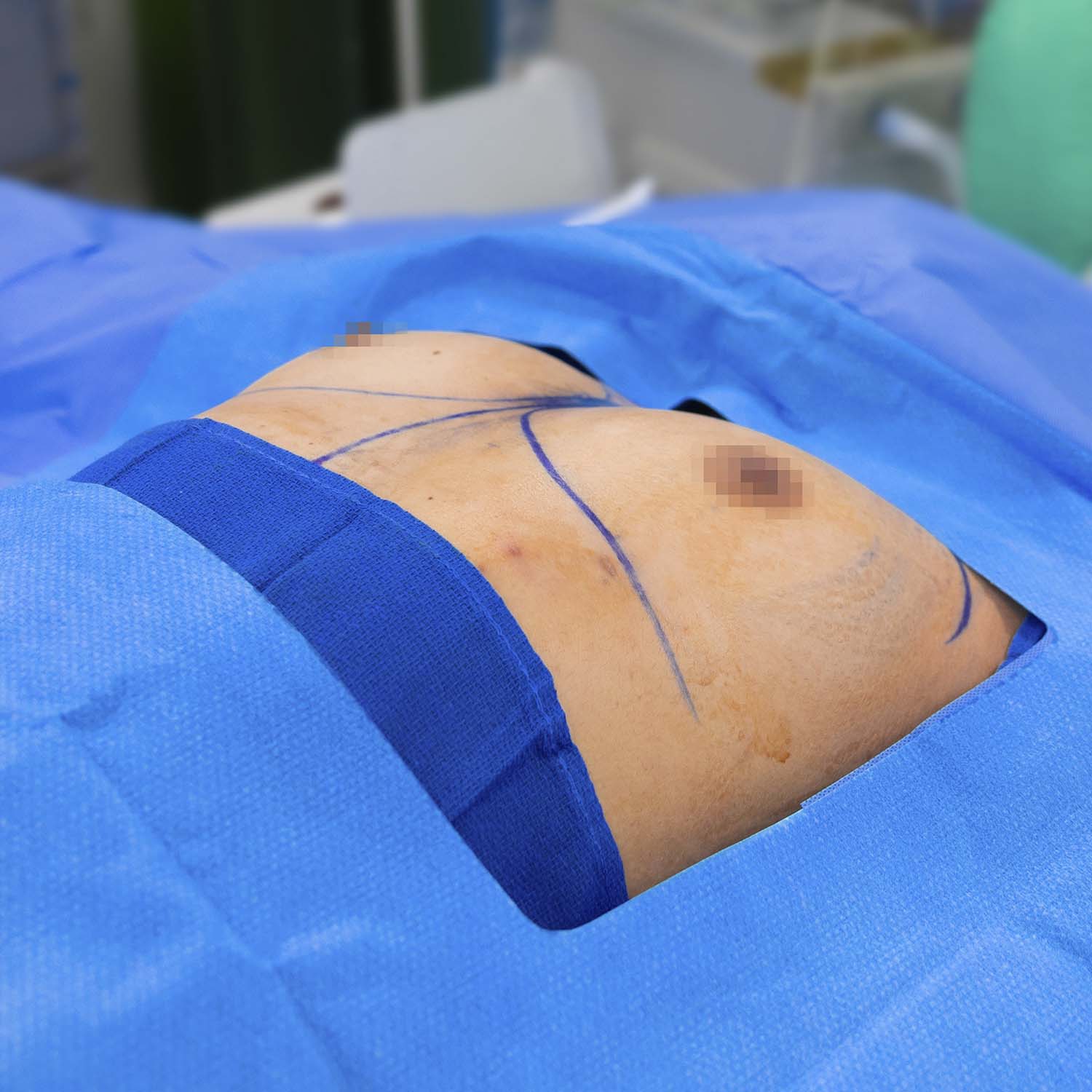 nosrati breast augmentation before