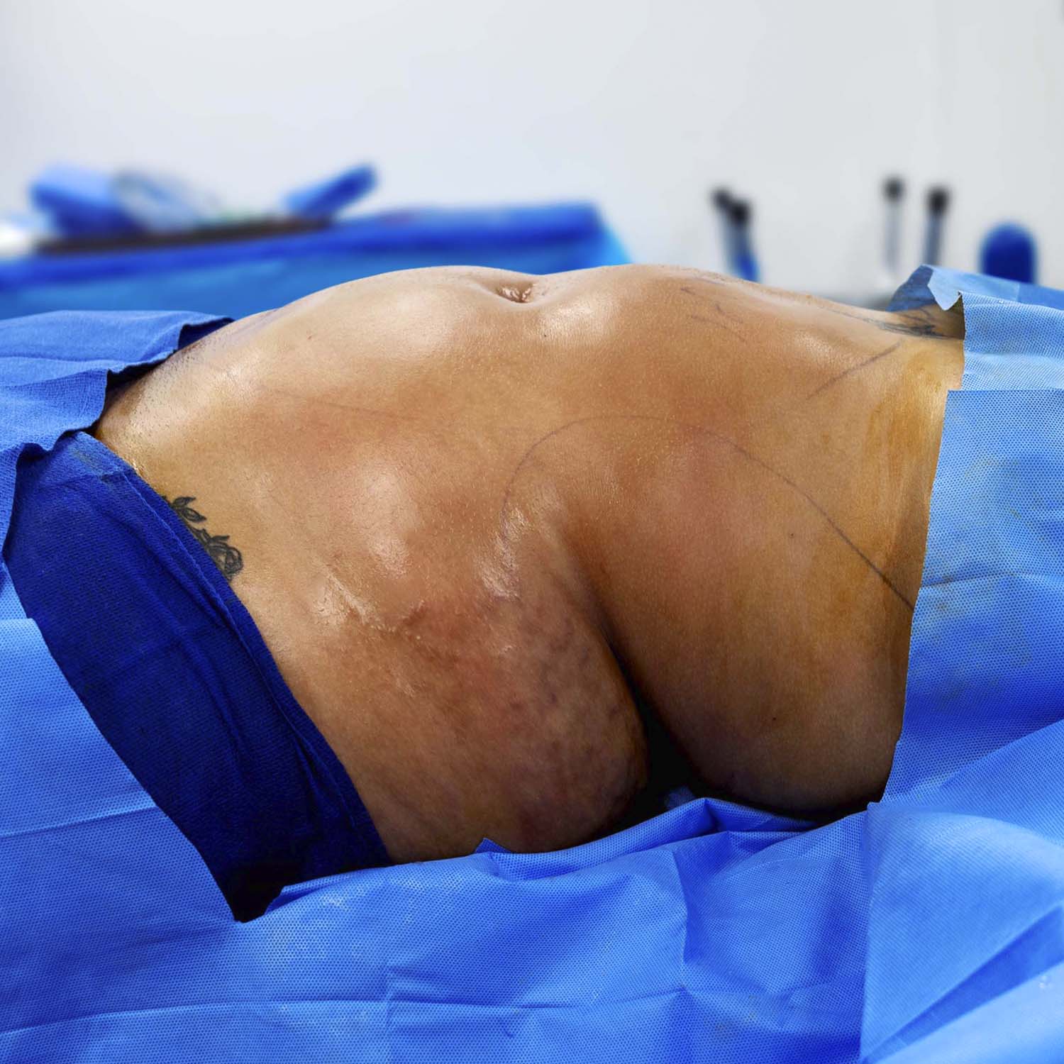 nosrati liposuction before