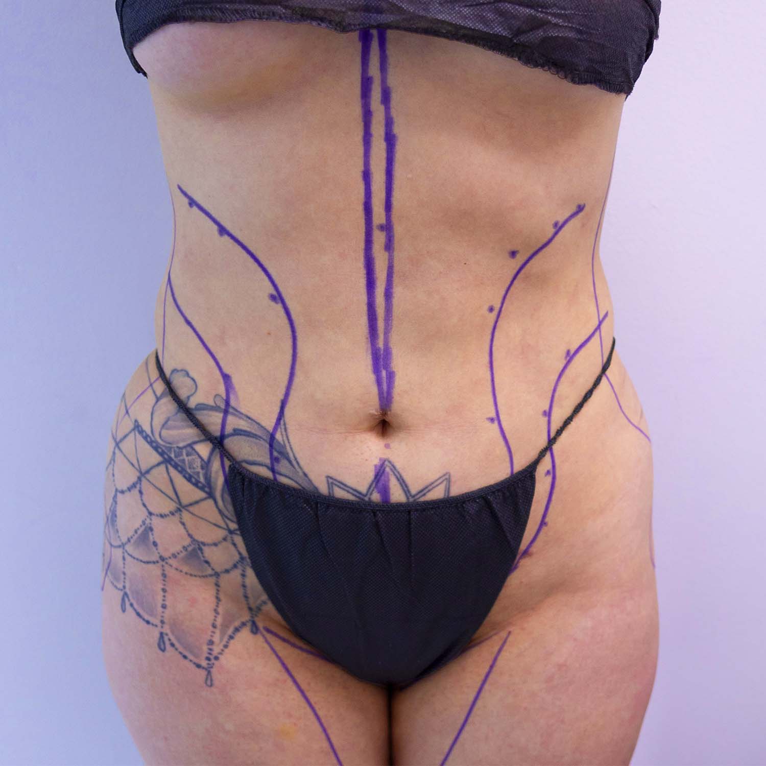 nosrati liposuction hd before