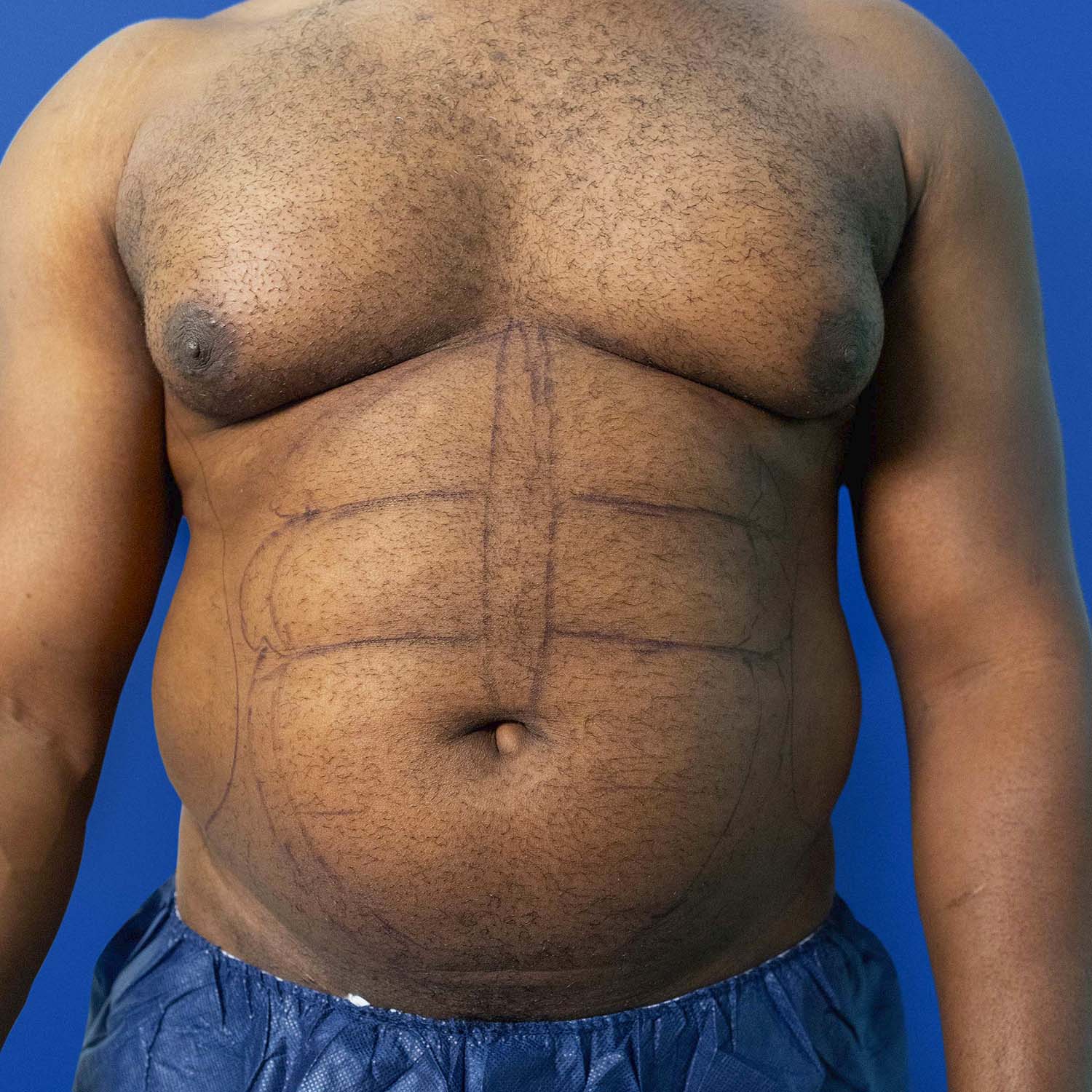 nosrati male lipo before