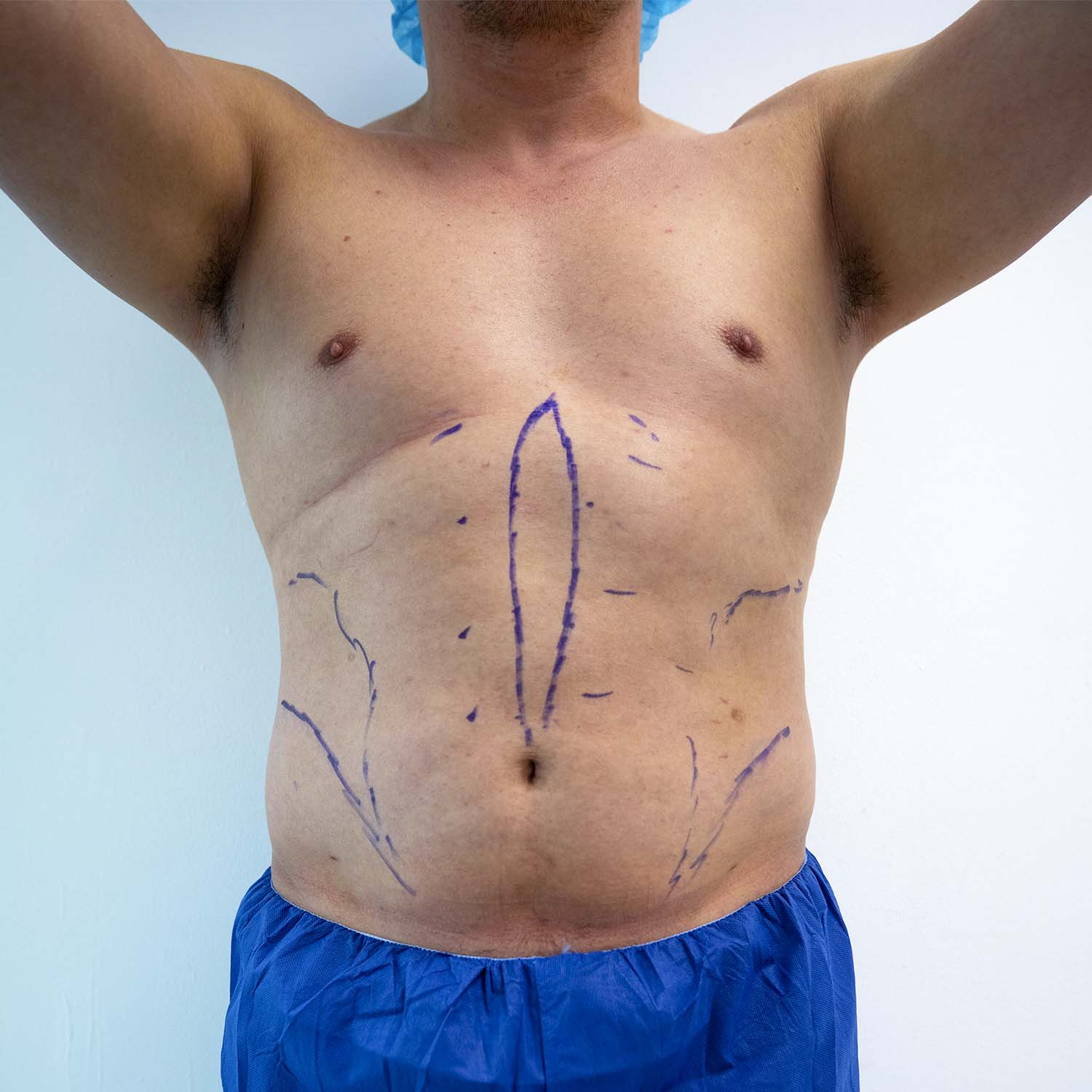 nosrati male patient liposuction before