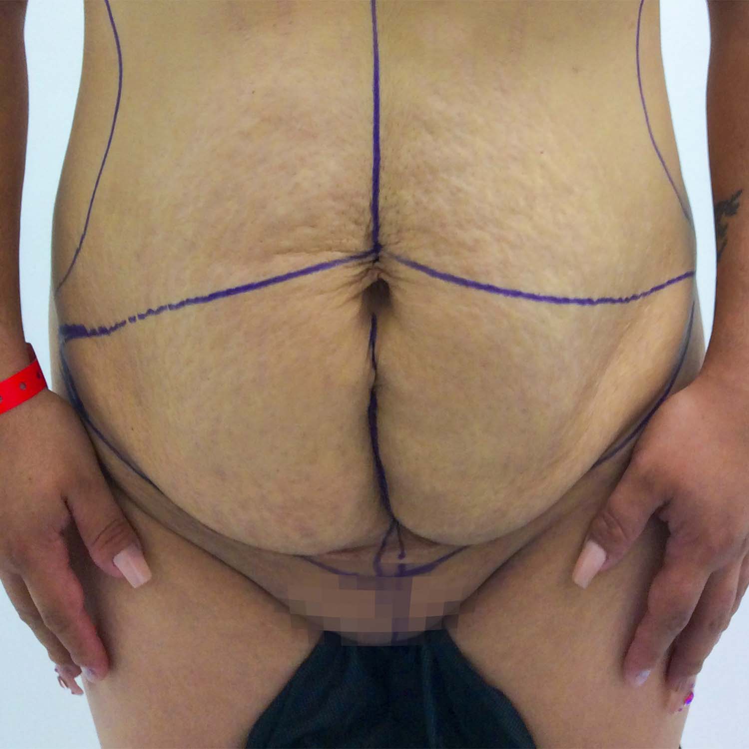 nosrati tummy tuck before