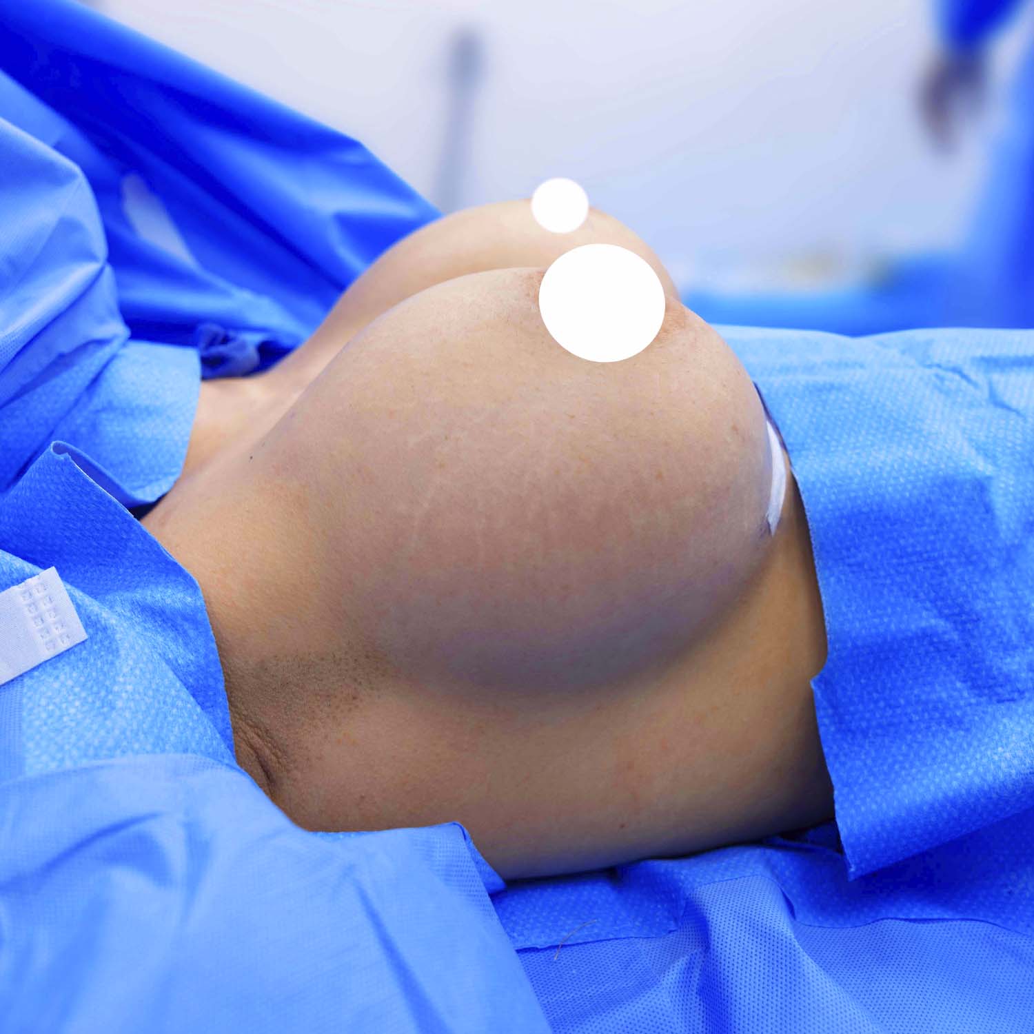 side view breast augmentation after