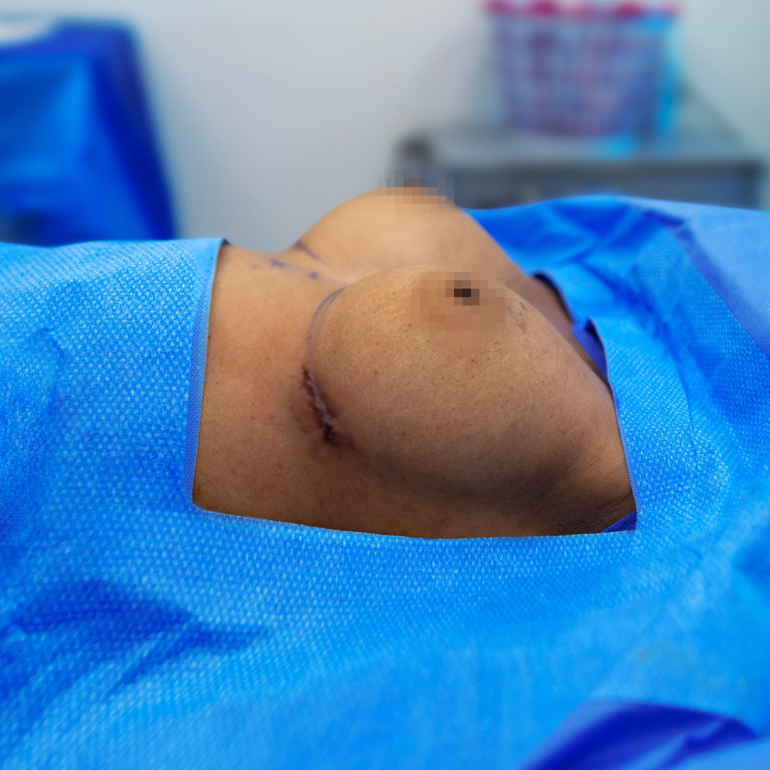 side view breast augmentation after