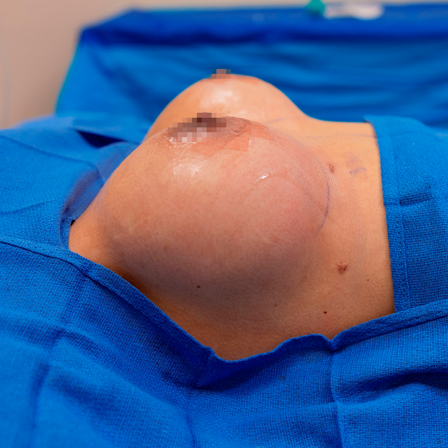 side view of digeronimo breast augmentation after