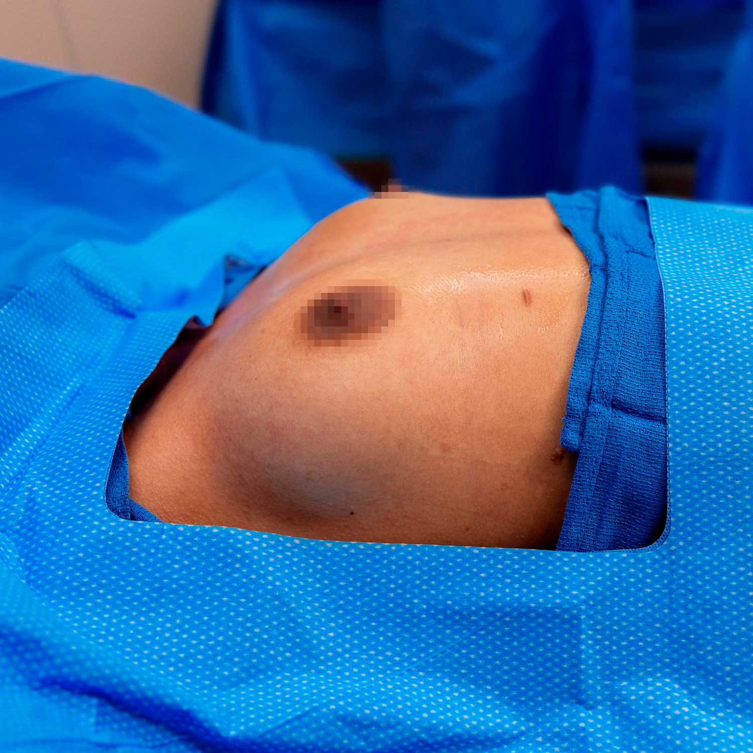 side view of digeronimo breast augmentation before