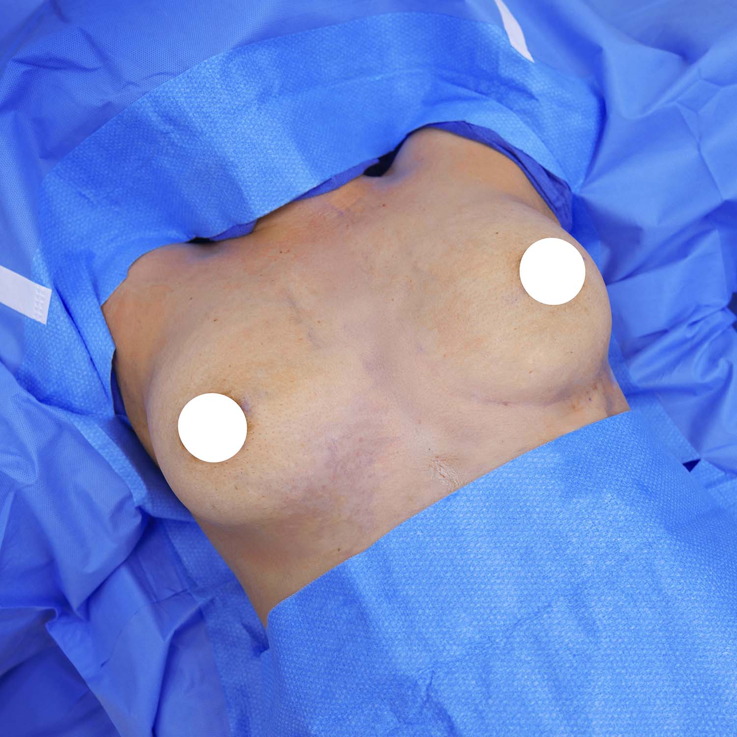 top view breast augmentation before