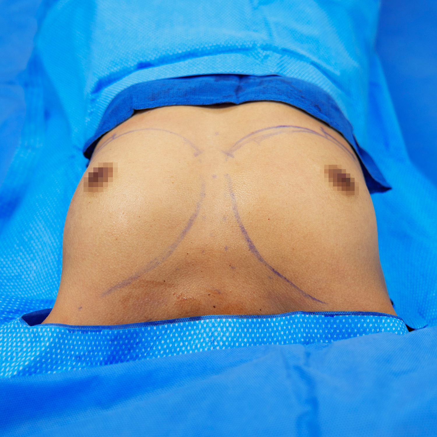 top view breast augmentation before