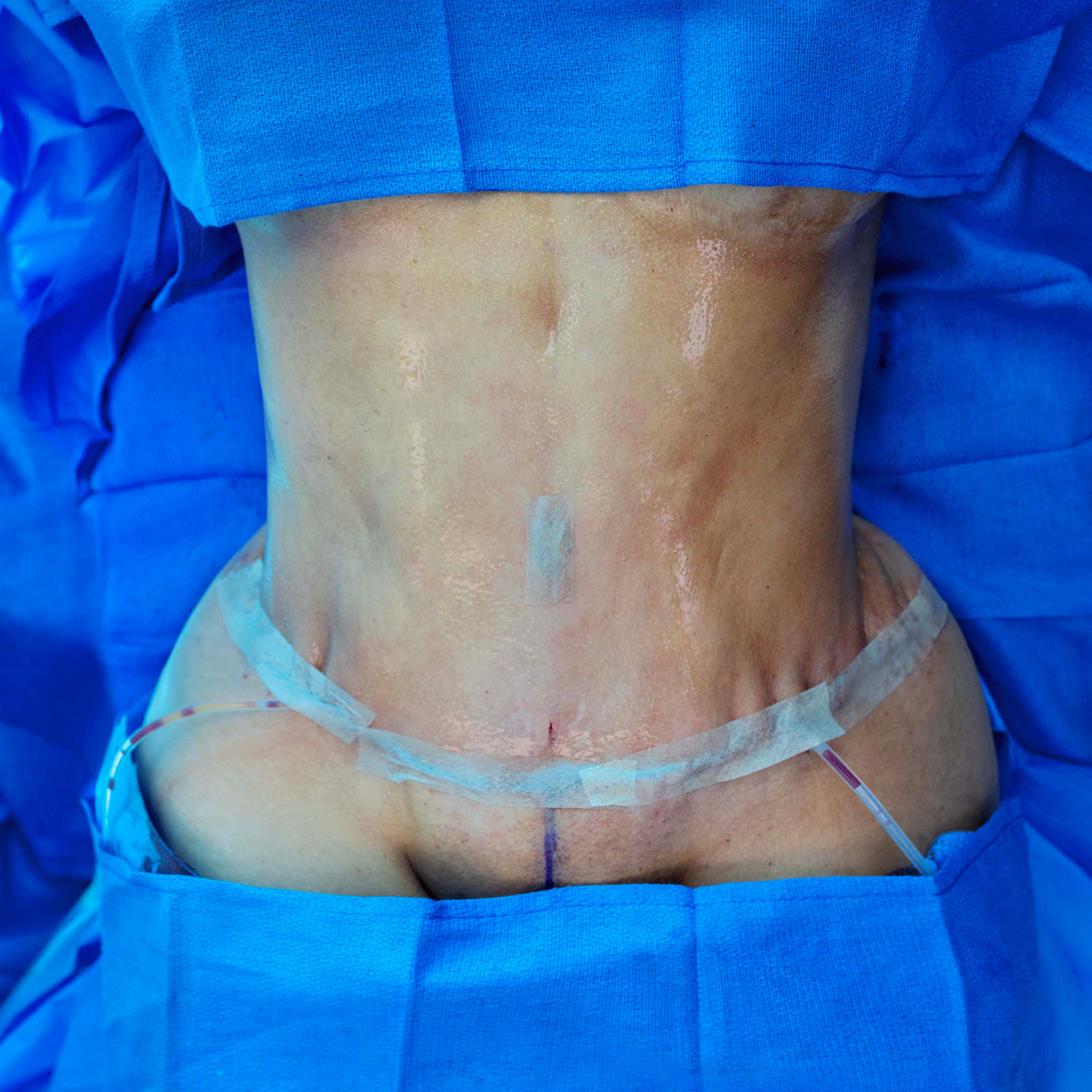 top view tummy tuck after