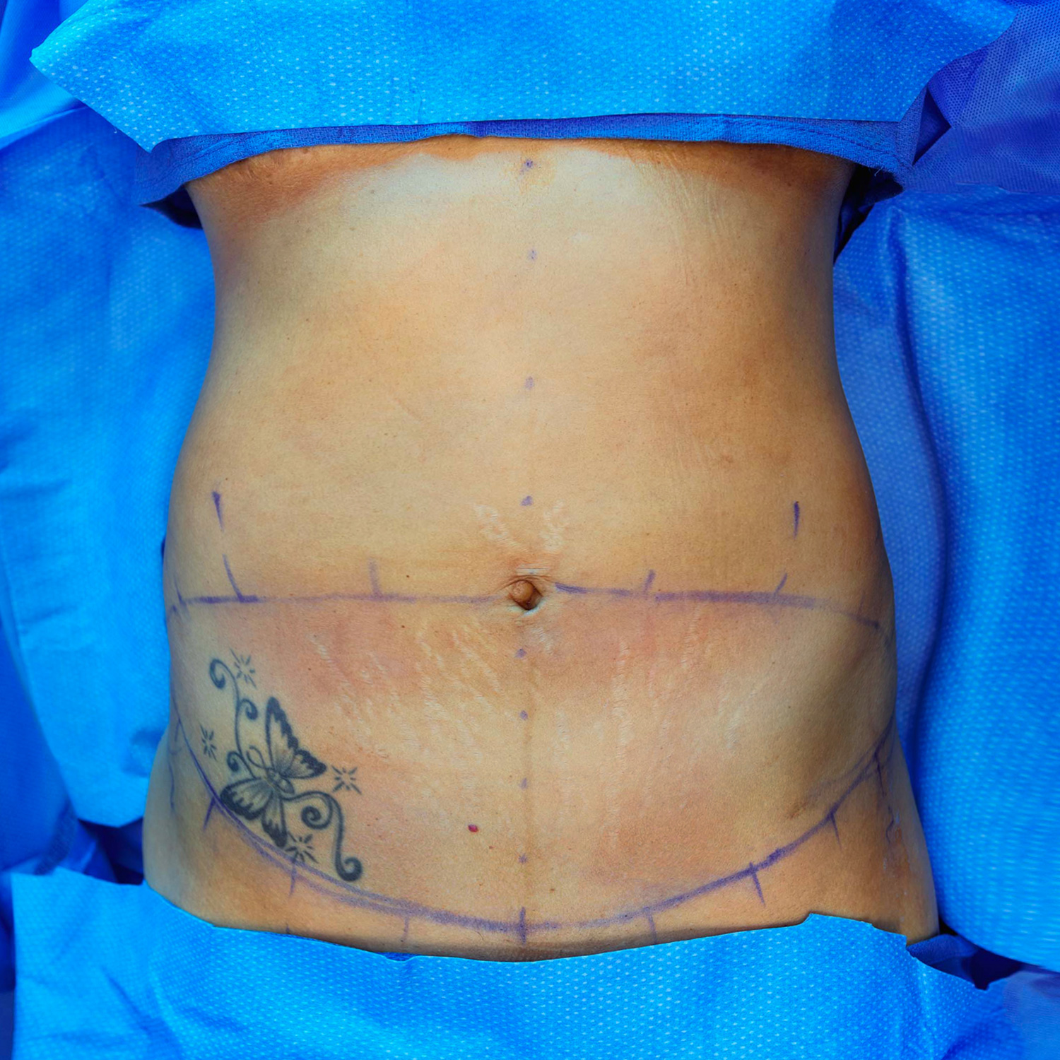 top view tummy tuck before