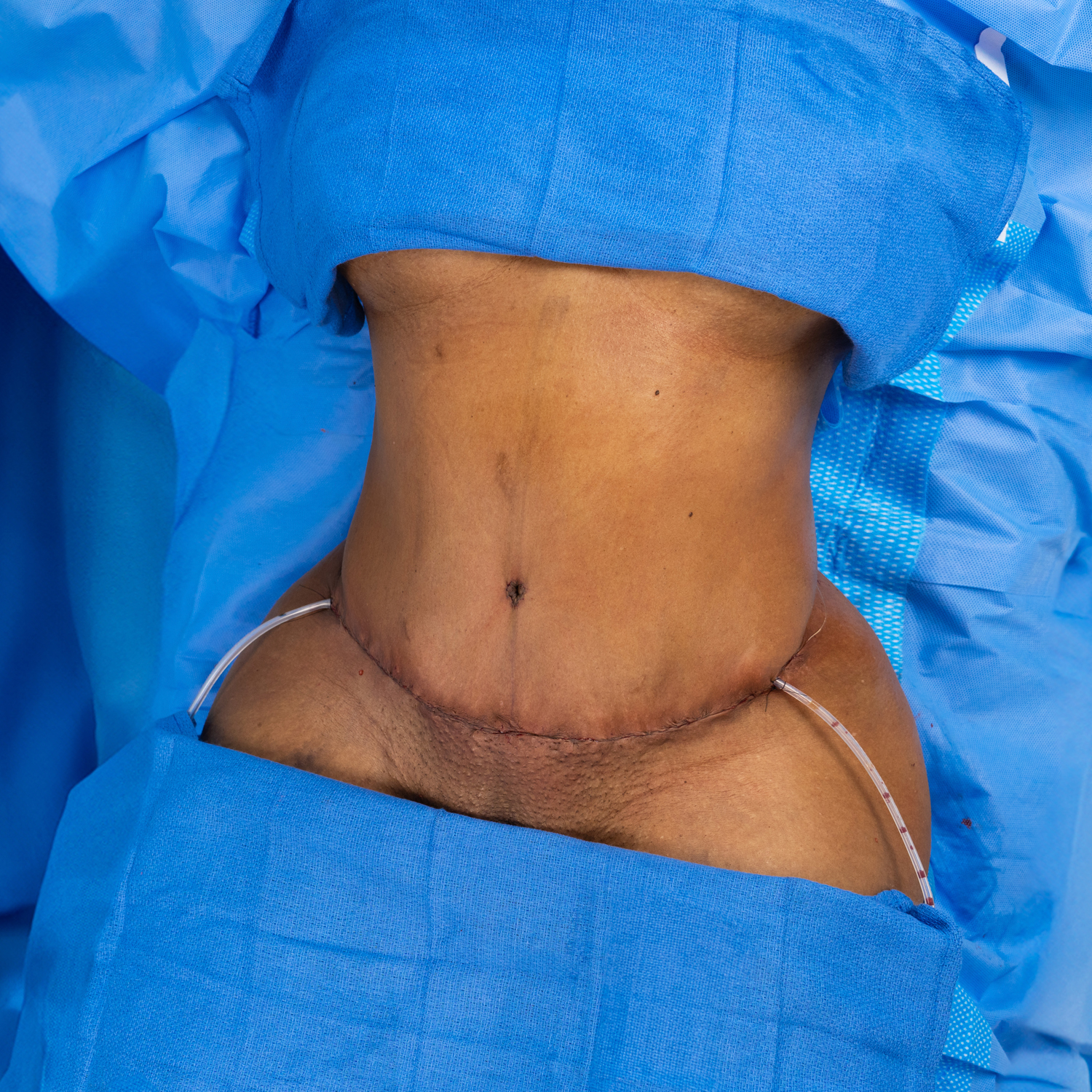 tummy tuck after