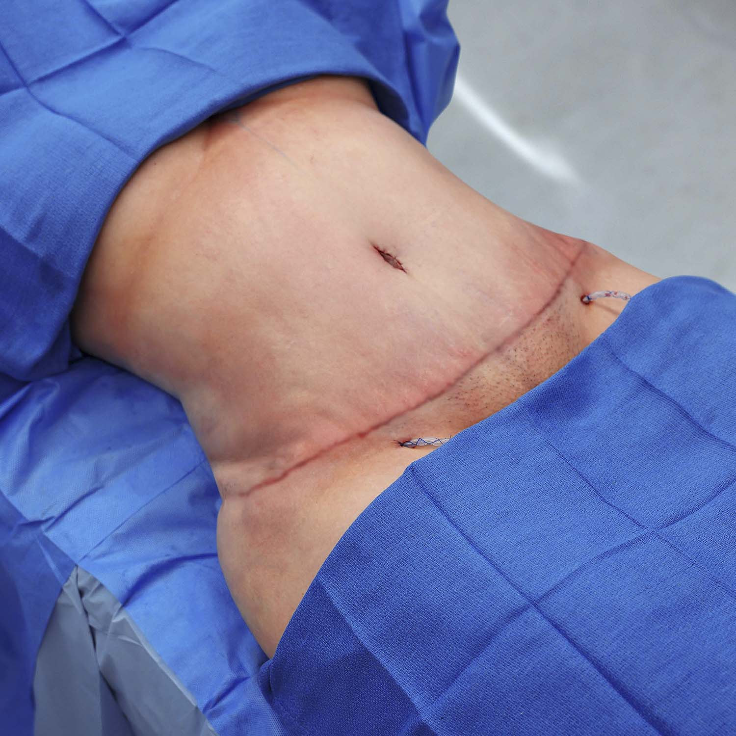 tummy tuck after