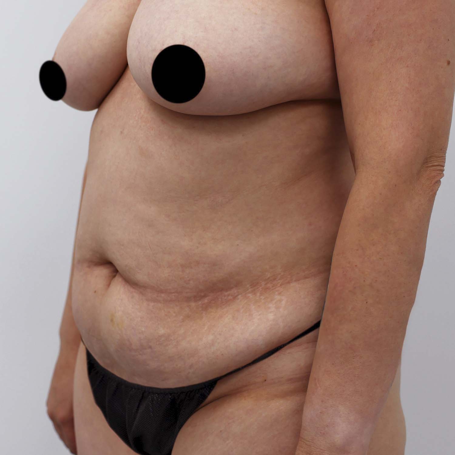 tummy tuck before