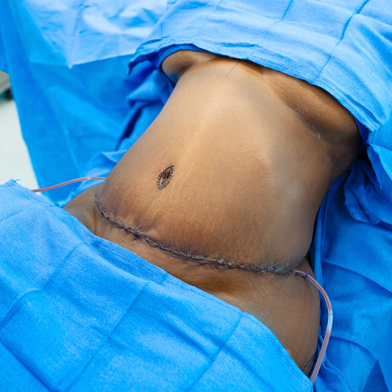 tummy tuck dr manny after