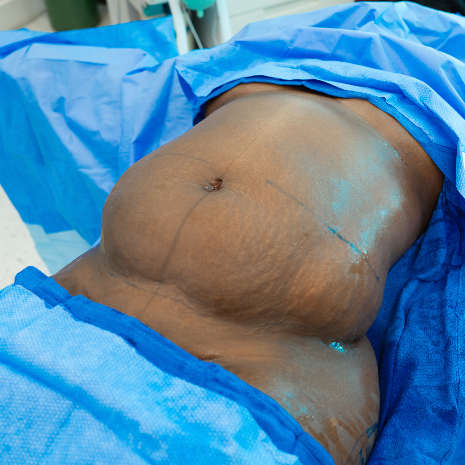 tummy tuck dr manny before