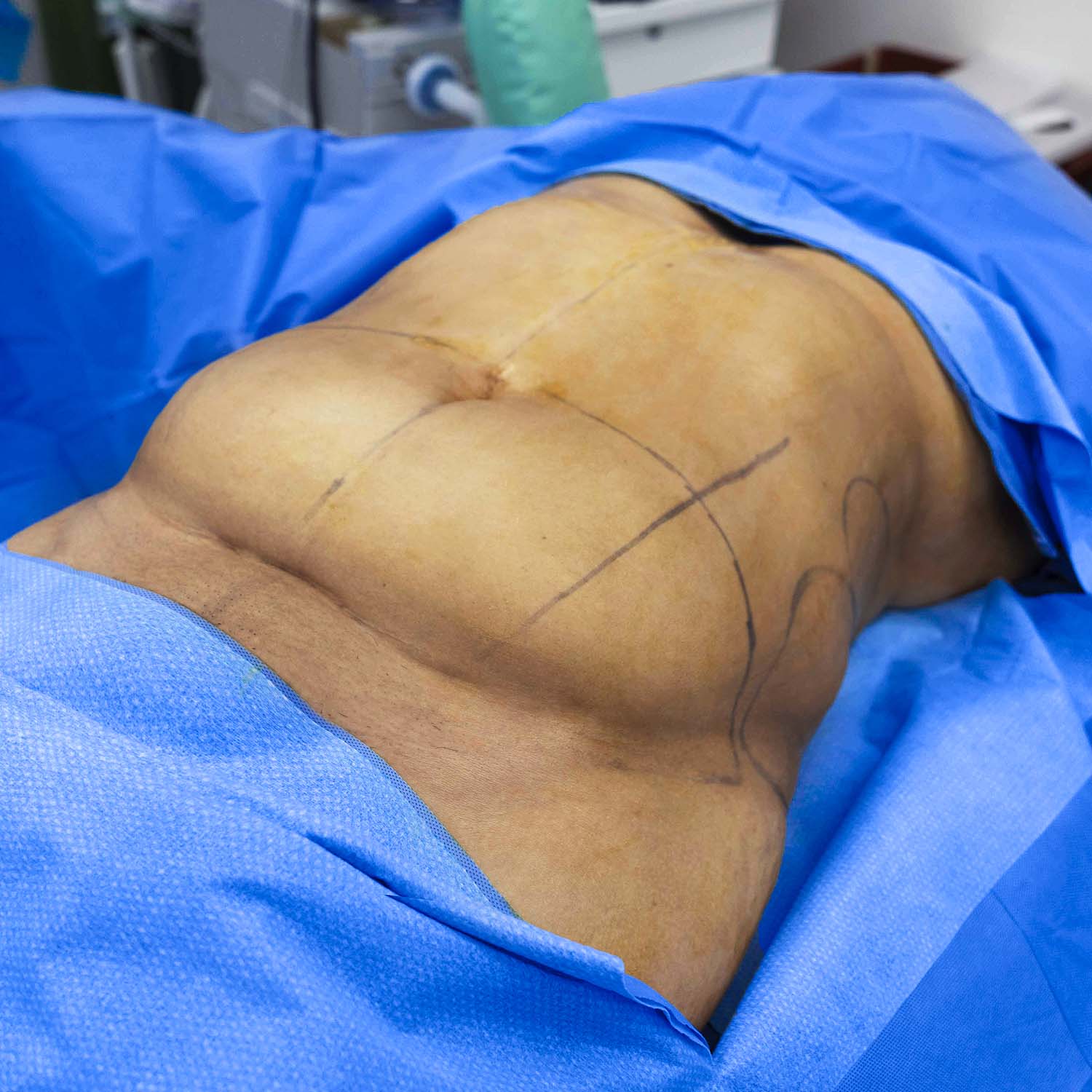 tummy tuck nosrati patient before