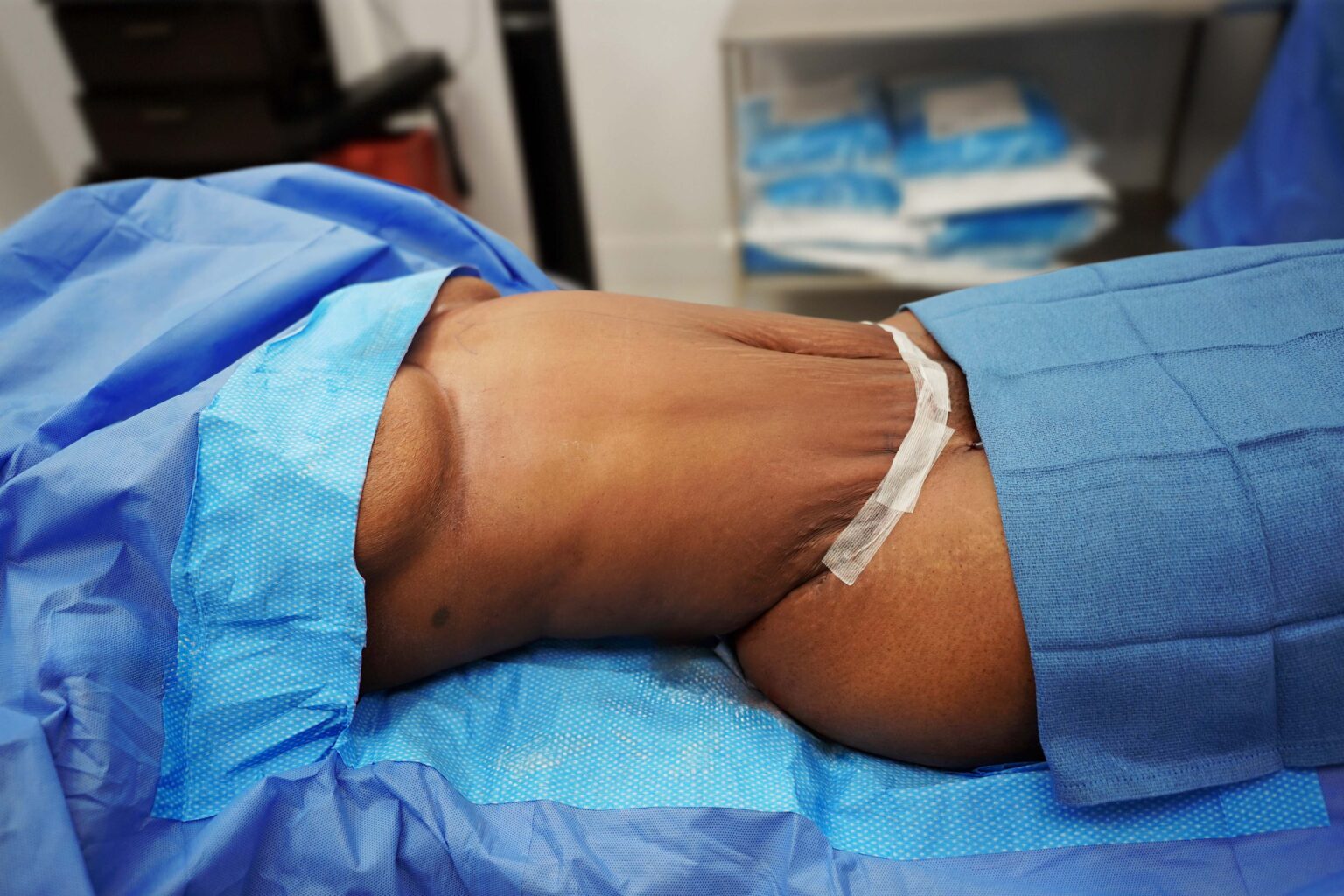 tummy tuck patient after