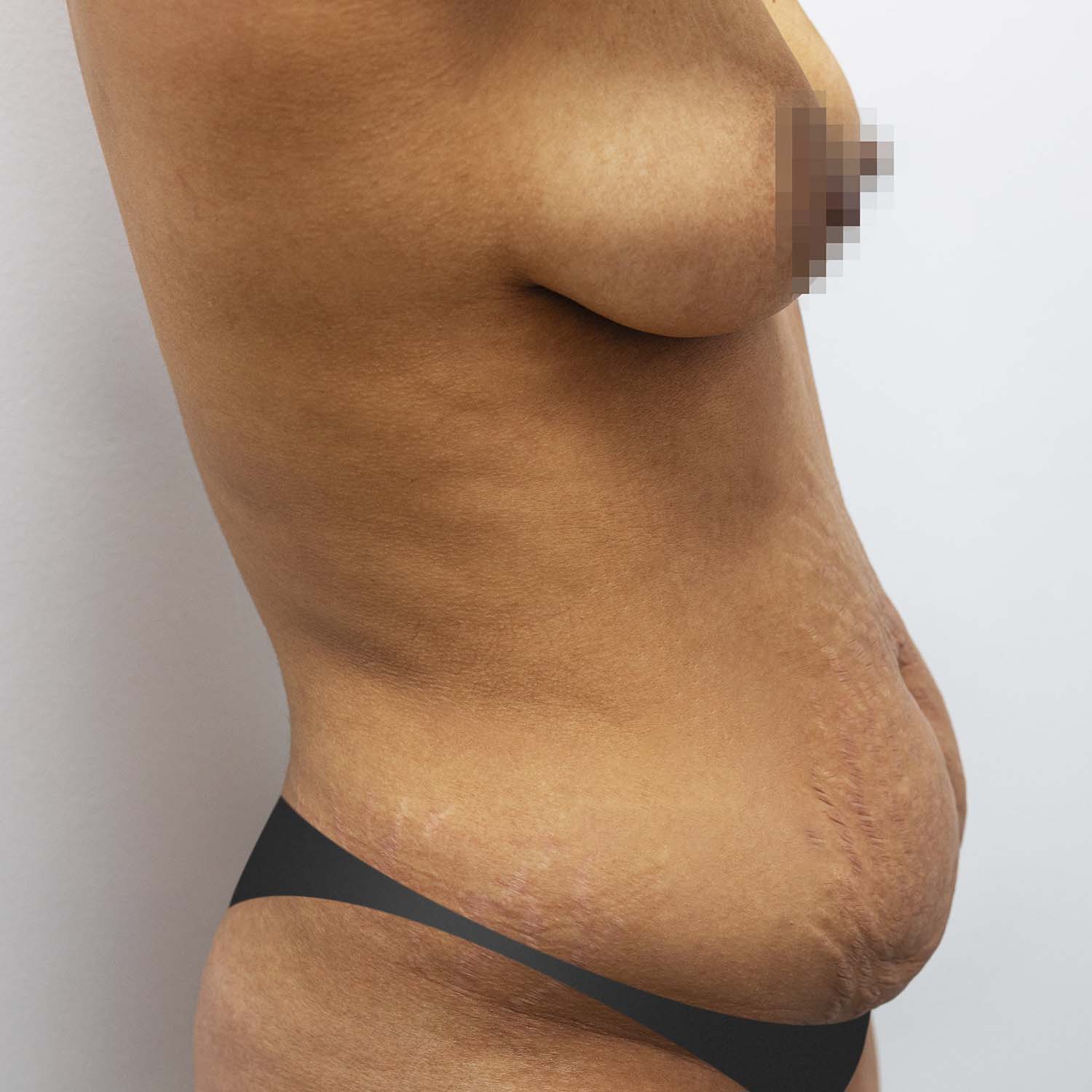 tummy tuck patient before