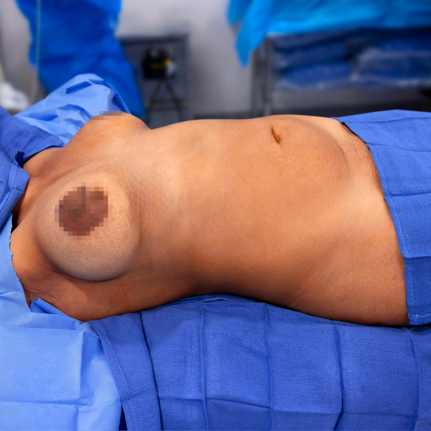 tummy tuck procedure before