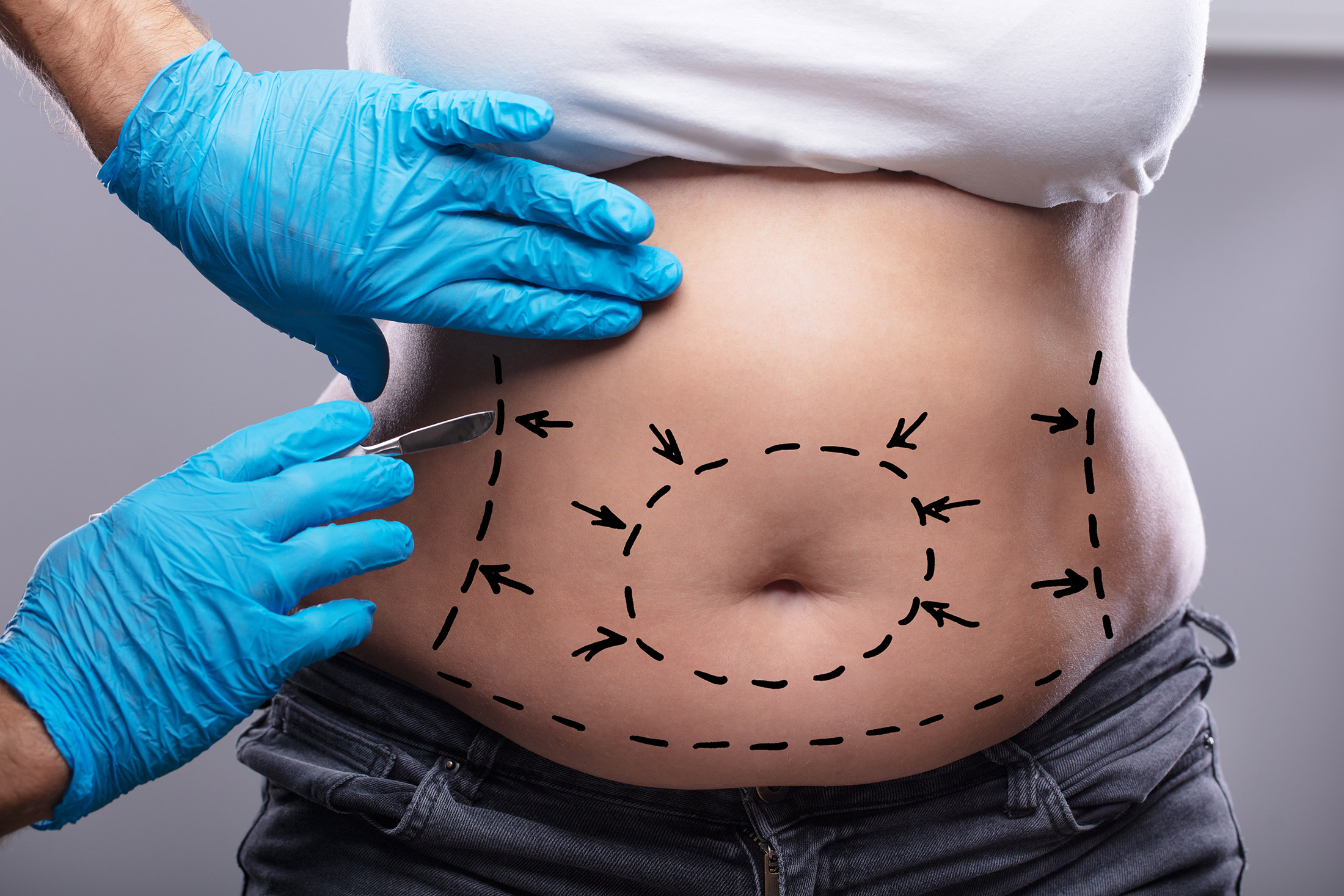 tummy tuck surgery lines on stomach